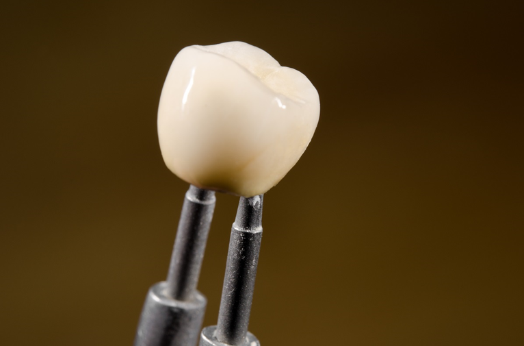 A Guide To Post-Fitting Care For Dental Implants