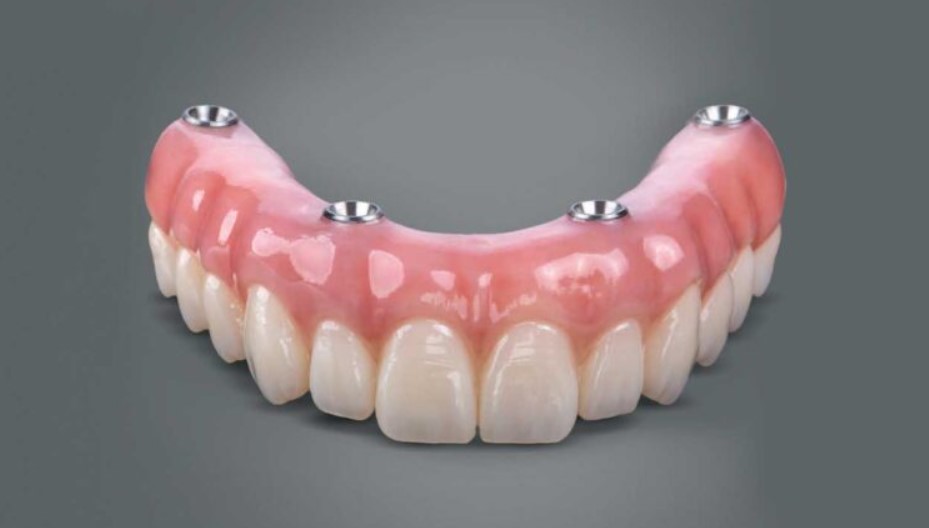 WHY SHOULD YOU OPT FOR ALL-ON-FOUR IMPLANTS?